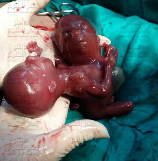 ملية اجهاض لسيدة تحمل طفل مشوه برأسين ورقبتين في جسد واحد