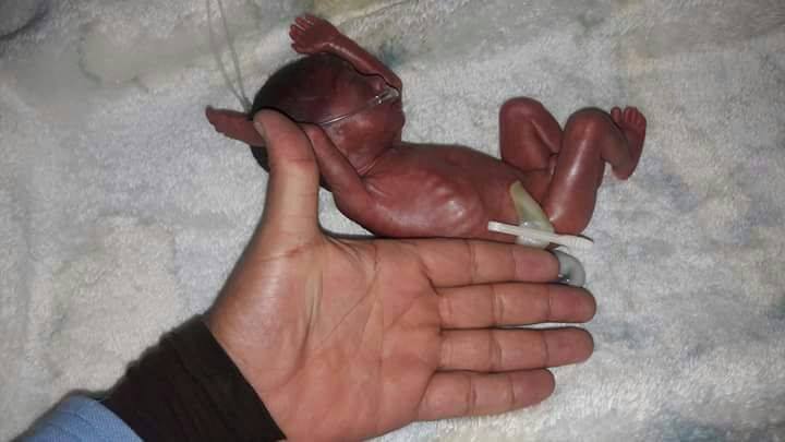  بالصور .. ولادة اصغر طفل فى العالم بمستشفى كفر الشيخ العام 