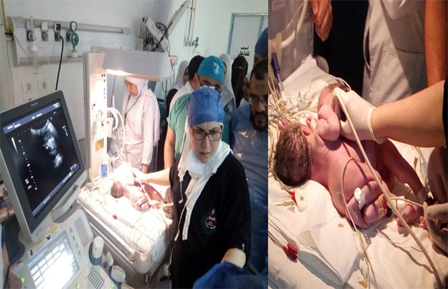   بالصور .. أول عملية ولادة لتوأم ملتصق من كفر الشيخ  بـ